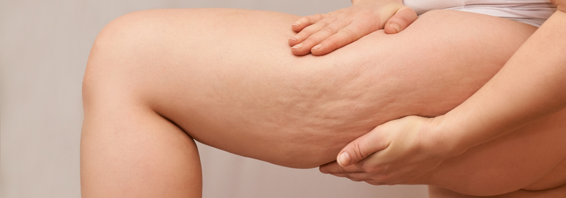 Understanding Cellulite: Your Guide to Causes and Solutions